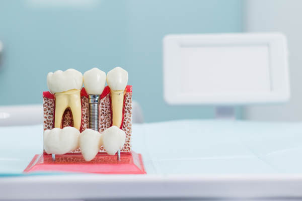 Do Dental Implants Look And Feel Natural?